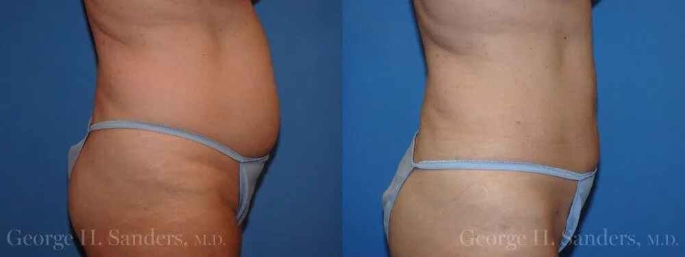 Liposuction before and after - before