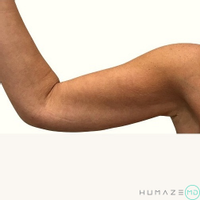 Combination Treatment by Dr. Timothy Neavin — after