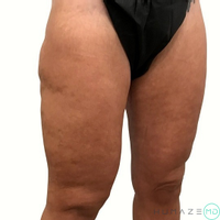 Thigh Lift before and after - after