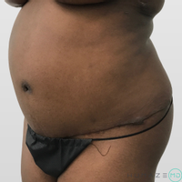 Breast Augmentation before and after - after