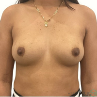 Breast Augmentation by Dr. Timothy Neavin — before and after