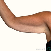 Combination Treatment by Dr. Timothy Neavin — before