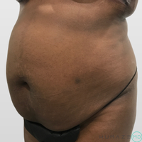 Breast Augmentation by Dr. Timothy Neavin — before and after
