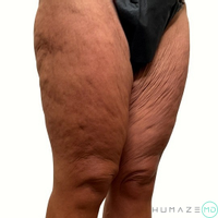 Thigh Lift by Dr. Timothy Neavin — before and after