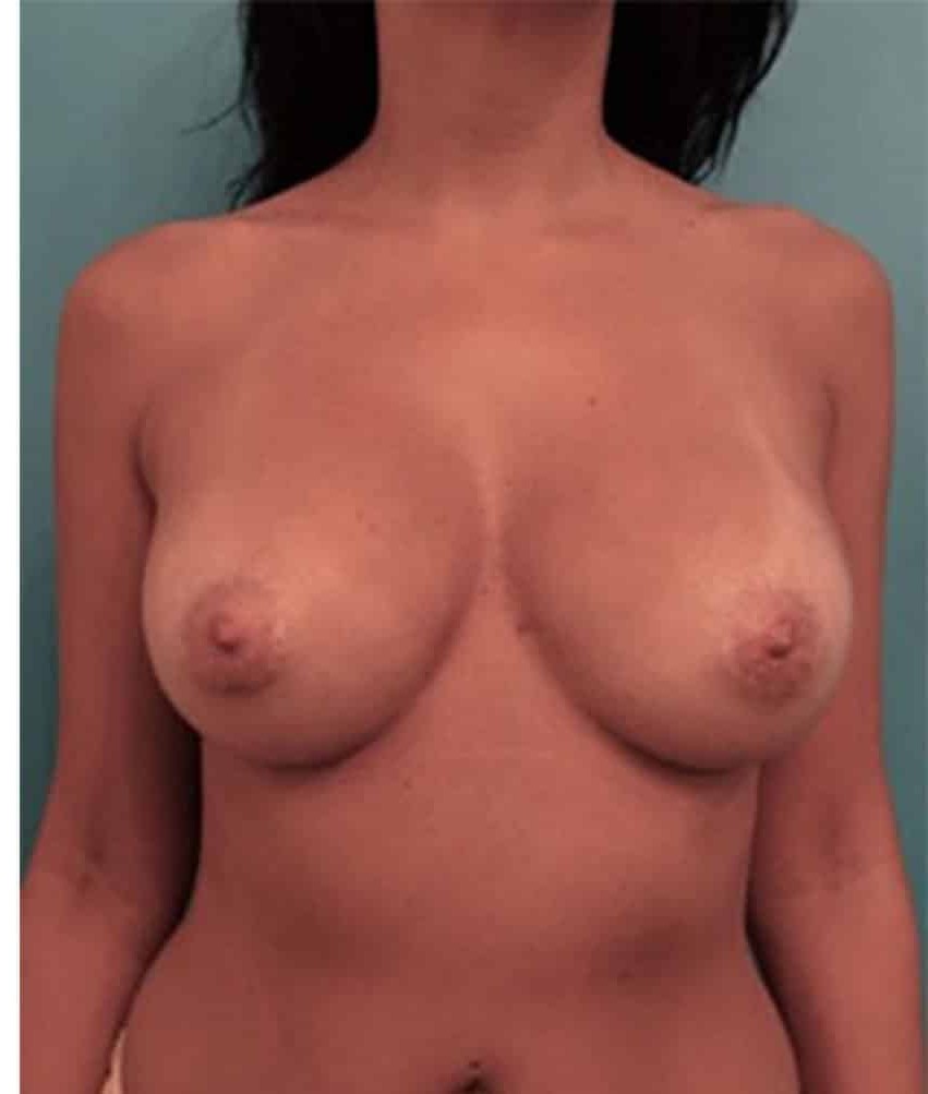 Breast Augmentation before and after - after