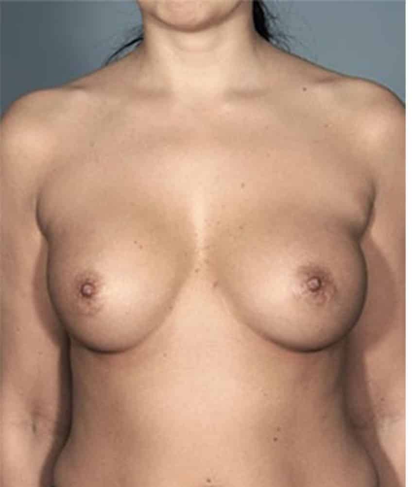 Breast Augmentation before and after - before