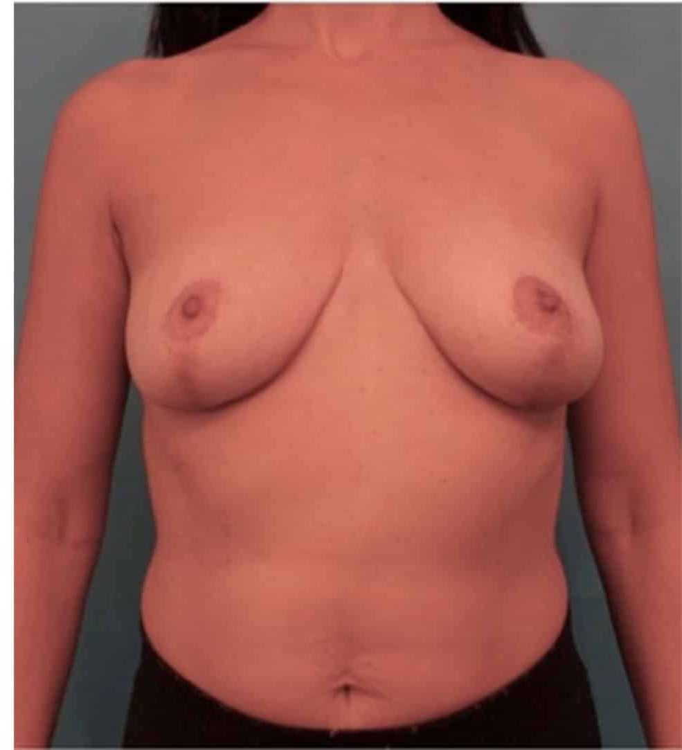 Breast Lift before and after - after