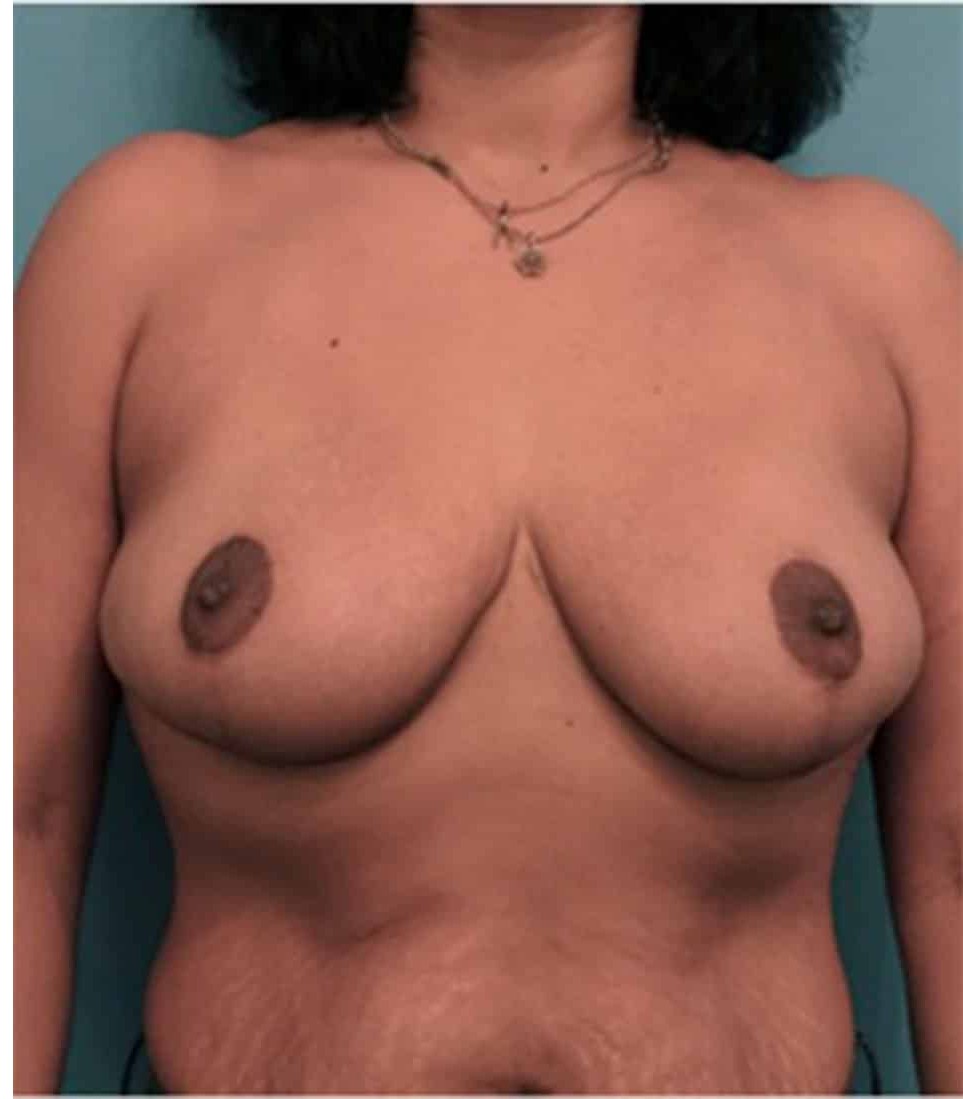 Breast Reduction before and after - after