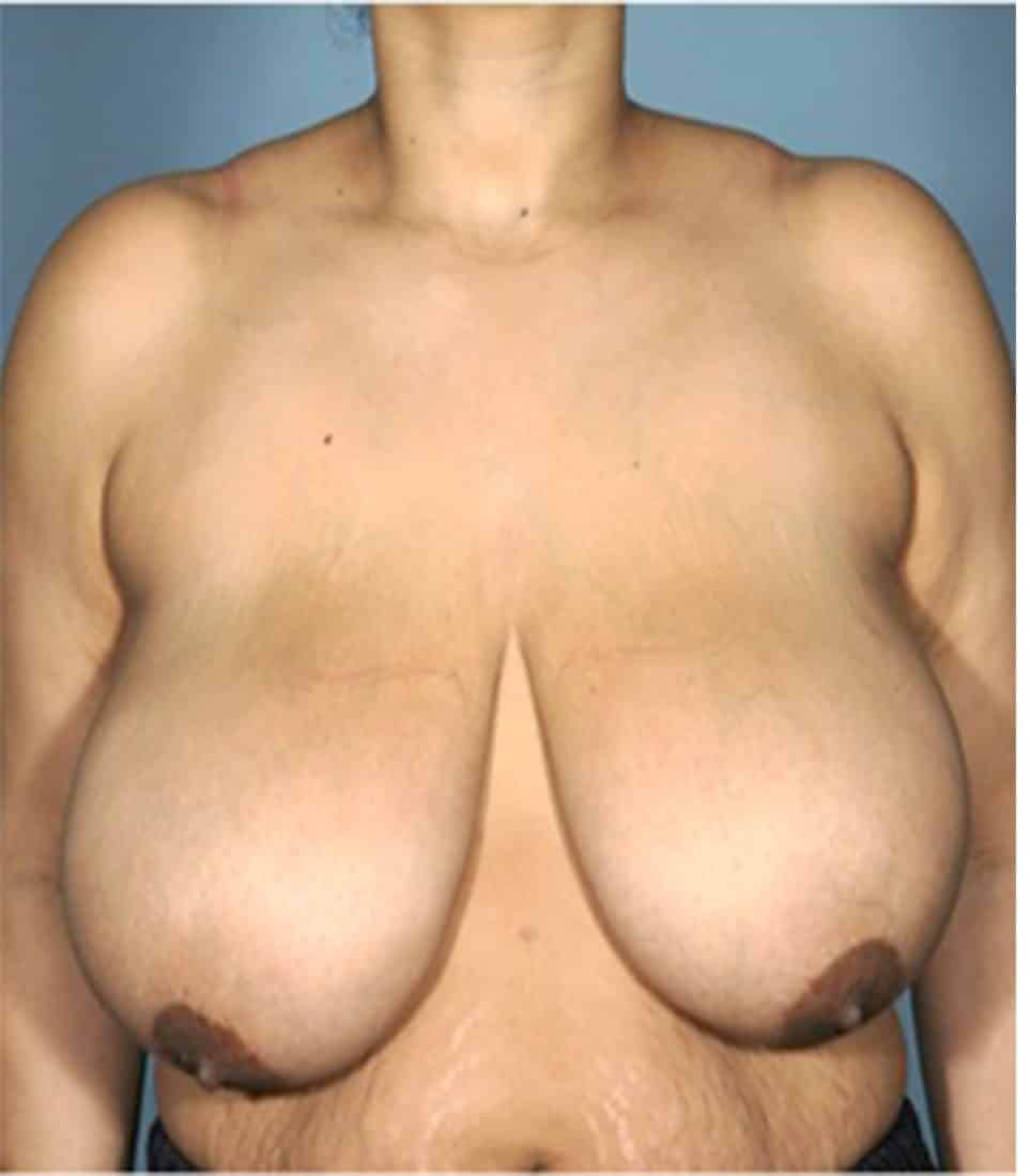 Breast Reduction before and after - before