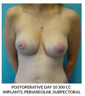 Breast Augmentation after — Dr. Samara Churgin