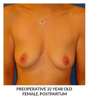 Breast Augmentation before — Dr. Samara Churgin