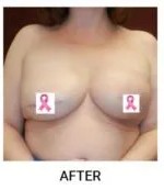 Breast Reconstruction after — Dr. Samara Churgin