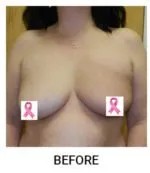 Breast Reconstruction before — Dr. Samara Churgin