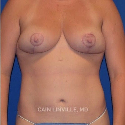 Mommy Makeover before and after - after