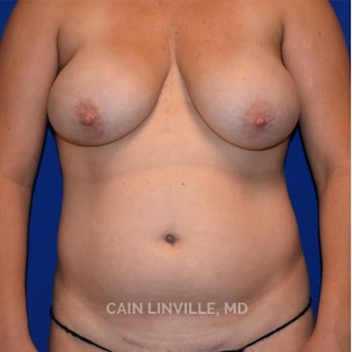 Mommy Makeover before and after - before