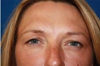 Botox before and after - after