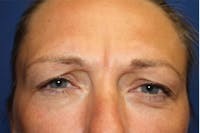 Botox before and after - before