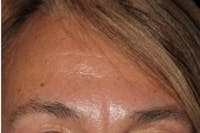 Botox before and after - after