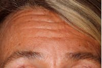 Botox before and after - before