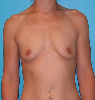 Breast Augmentation before and after - before