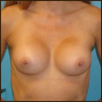 Breast Augmentation before and after - after
