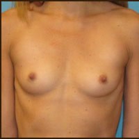 Breast Augmentation before and after - before