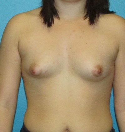Breast Lift before and after - before