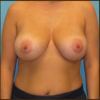Breast Lift before and after - after