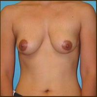 Breast Lift before and after - after