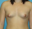 Breast Lift before and after - before