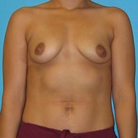 Breast Augmentation before and after - before