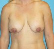 Breast Lift before and after - before