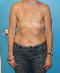 Procedure before and after - before