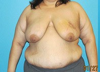 Procedure before and after - before