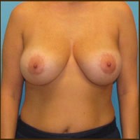 Breast Augmentation before and after - after
