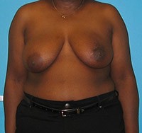 Procedure before and after - before