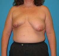 Procedure before and after - before