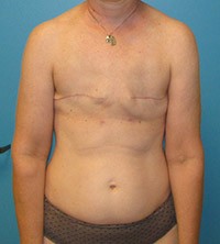 Procedure before and after - before