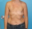 Procedure before and after - before