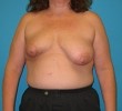 Procedure before and after - before