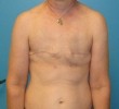 Procedure before and after - before