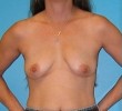 Procedure before and after - before