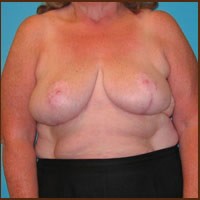 Breast Reduction before and after - after