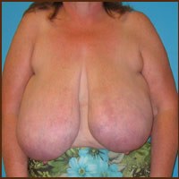 Breast Reduction before and after - before