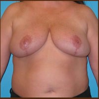 Breast Reduction before and after - after