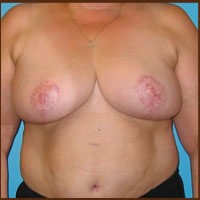 Breast Reduction before and after - after