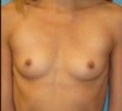 Breast Augmentation before and after - before
