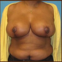 Breast Reduction before and after - after
