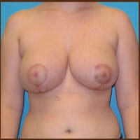 Breast Reduction before and after - after
