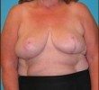 Breast Reduction before and after - after